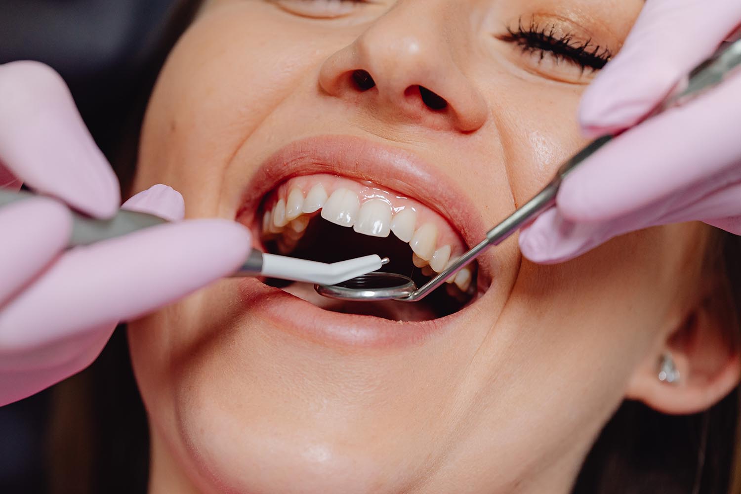 ¿Qué son las Incrustaciones Dentales?